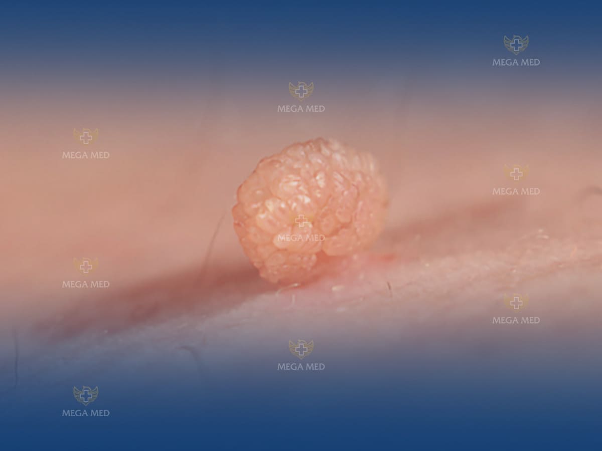 Sùi mào gà ở ngực chữa được